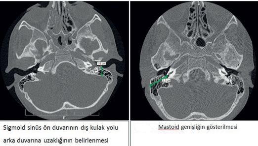 Sol Mastoid Hücrelerde Havalanma Kaybı Nedir? Belirtileri, Nedenleri ve Tedavi Yöntemleri